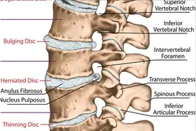 患有腰椎间盘突出的人，是否终生不能剧烈运动和从事体力劳动？图片