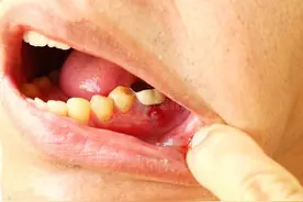 牙龈上火肿痛难忍？这些降火止痛妙招快收藏！图片