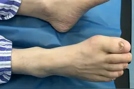 痛风一般疼多久能自动消退？图片