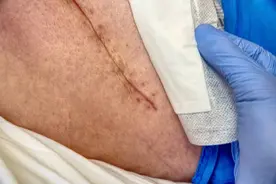 人体各个部位手术切口愈合时间是多久？切口不愈合怎么办？图片