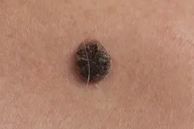 身体多处有黑斑，小心皮肤癌！这几个症状要小心图片