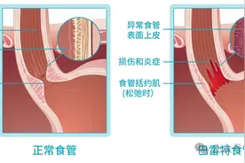 癌前病变——巴雷特食管，到底长啥样？该怎么治？图片