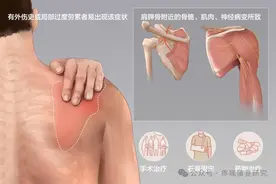 肩胛骨疼痛的 9 种病因和 7 种治疗图片