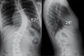 防治青少年脊柱侧弯已经是国策了，这些知识，家长必须了解图片