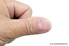 为什么指甲有竖纹？提醒：指甲出现竖纹，和这些原因有关，多留意图片