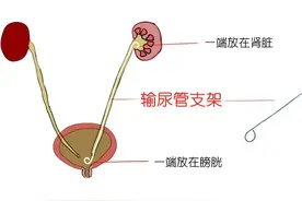 为什么肾结石手术后经常出现腰腹部疼痛和血尿？图片