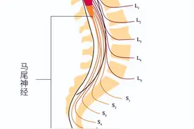 腰椎间盘突出患者注意：出现什么表现就要当心马尾神经综合征？图片