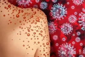 2周3起猴痘病例，新加坡紧急发布入境新规！从海外回中国要申报检图片