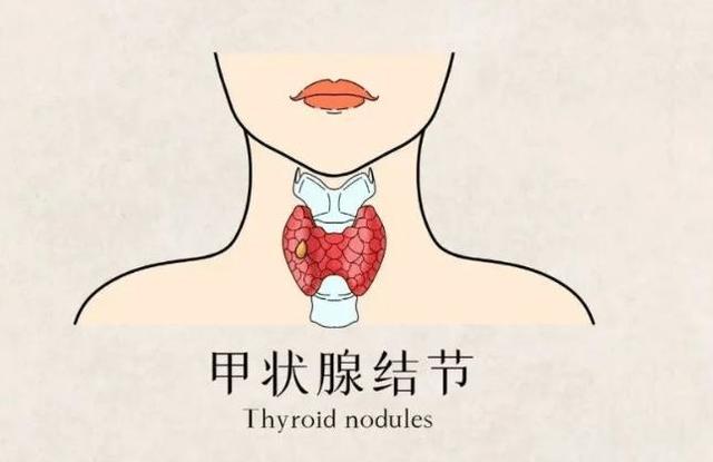 逍遥丸治好甲状腺结节 2026年逍遥丸治甲状腺结节吗