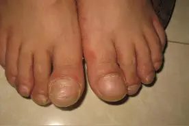 双脚一旦出现5种异常，一定要趁早去医院！拖久了或会疾病缠身！图片