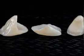 想做牙齿贴面，五件事你必须要知道图片