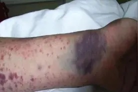 炸裂式头痛、喷射状呕吐，男子硬撑3天进ICU！中疾控提醒：不是感冒，正高发图片