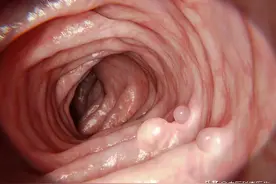 肠息肉，用中医药化瘀散结，还是外科手术“一刀切”？哪个更好？图片