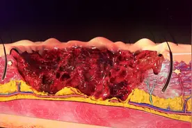 烫伤后黄金5分钟，正确处理不留疤不感染。图片