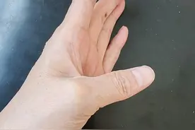 一路走来，腱鞘炎患者的辛酸泪图片