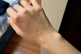 荨麻疹不会无故来临！医生发现：患荨麻疹的人，背后或有4个原因图片