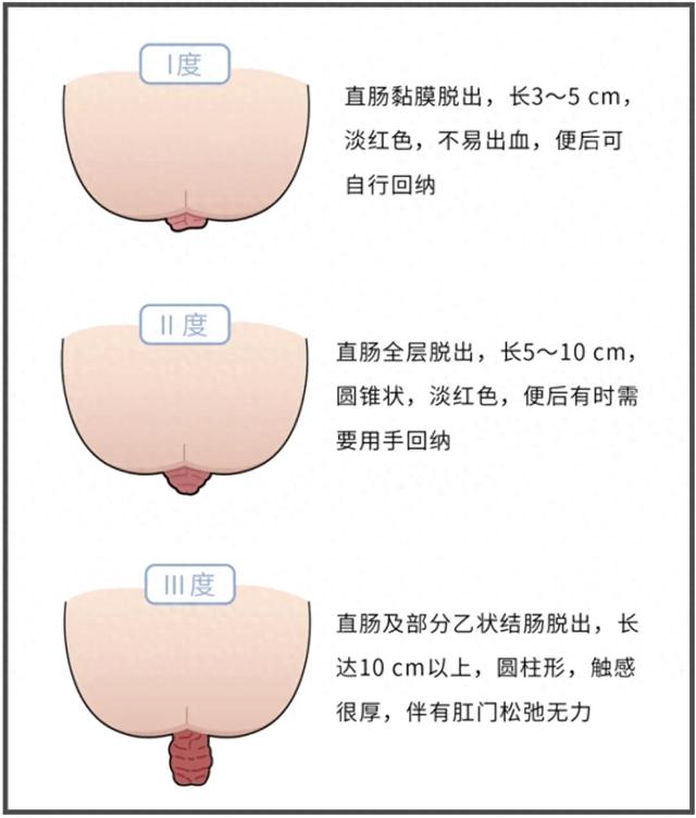 什么是直肠脱垂（什么是直肠脱垂如何分度如何诊断及鉴别诊断 一）