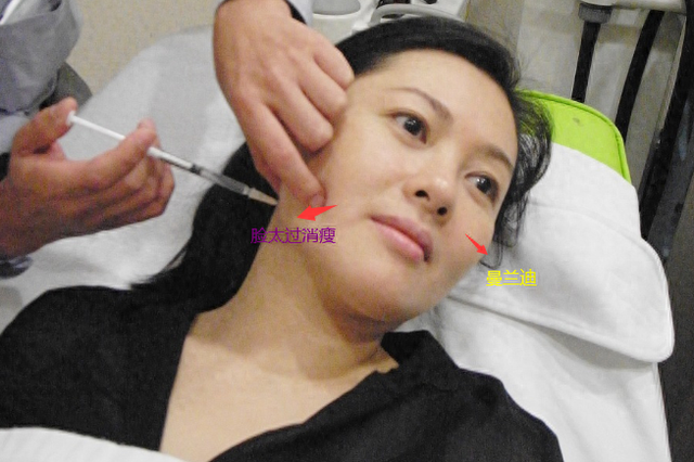 脸太瘦如何让脸部饱满 2026年脸太瘦如何让脸部饱满有药吃吗