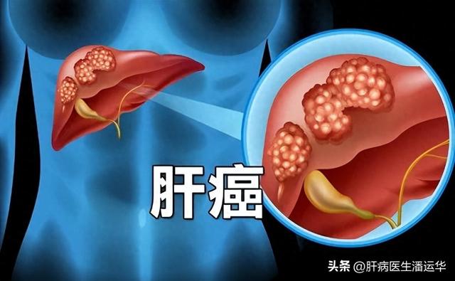 得了原发性肝癌能活多久（得了肝癌究竟能活多久肝病专家跟你说实话）