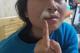 终于去取了我嘴巴周围的痣，激光7颗，手术切了一颗图片