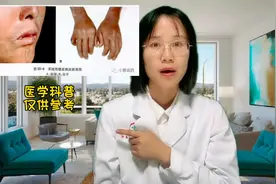 皮肤变硬是一种病，它的名字叫硬皮病#医学科普图片