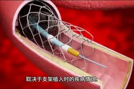 心脏支架就不能工作了吗？图片