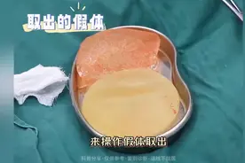 宝妈10年的胸假体终于取出来，换脂肪丰胸，打造出深V乳沟图片