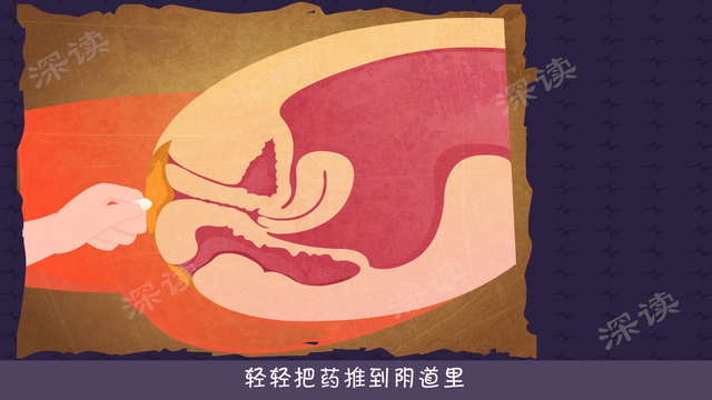 阴道炎4：阴道炎的治疗方法大全 #阴道炎