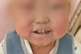 9岁白血病男孩终于出院了#白血病#男孩#出院