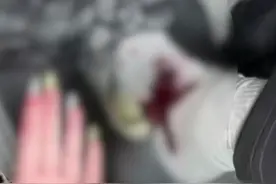 游客称在玉龙雪山被蚂蝗叮，脚部出血渗出鞋子，景区：蚂蝗是自然现象，准备了消毒酒精#媒体精选计划 #玉龙雪山 #蚂蝗 #血