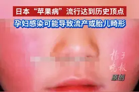 日本“苹果病”流行达到历史顶点，孕妇感染可能导致流产或胎儿畸形