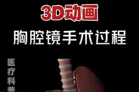 3D胸腔镜手术过程。#每个人都是自己健康的第一责任人 #肺结节 #医学科普 #专业的事交给专业的人 #3d动画演示 #沉浸式解压视频大全