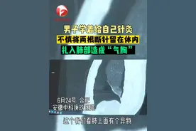 男子学着给自己针灸 两根断针进入体内 造成气胸。医生手术取出，#造成气胸医生视频封面