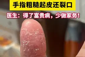 手指头开裂起硬皮，一碰水就很疼，这不是简单的干燥！当心角化型湿疹#湿疹 #医学科普 #健康 #抖出健康知识宝藏#开工去班味健康指南