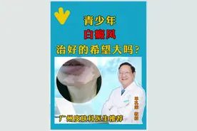 青少年白癜风治好的希望大吗? #广东白风医生推荐 #硬核健康科普行动 #单孔荣医生 #儿童白癜风 #挂单孔荣号视频封面