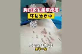 胸口多发瘢痕疙瘩，环钻治疗中... #疤痕 #疤痕疙瘩 #疤痕体质 #环钻 #瘢痕疙瘩