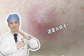 火疖子该怎么处理？可千万别挤！#火疖子 #痘痘 #火疖子是什么原因引起 #科普 #冷知识