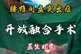 腰椎间盘突出症，开放融合手术！最彻底的减压方式#手术室日常 #微创手术 #医务人员的日常 #腰椎间盘突出症 #硬核健康科普行动视频封面