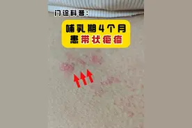 门诊科普：哺乳期4个月患带状疱疹 家长小心传染孩子得水痘。因为水痘和带状疱疹都是水痘-带状疱疹病毒感染引起的。#医学科普#带状疱疹 #水痘 #新手爸妈必看 #硬核健康科普行动视频封面