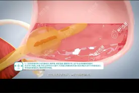 男性导尿管医疗手术3D动画 #导尿管医疗动画 #医疗动画 #医疗器械动画 #海南三维动画