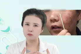 脱皮祛斑的后果和危害都有哪些？ #祛斑 #淡斑 #黑色素提取 #皮肤美容 #硬核健康科普行动