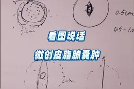 看图说皮脂腺囊肿微创手术 皮脂腺囊肿微创剥离可以减小切口长度，是个很好的手术方式。但是不是所有人都适合，也不是百分百能成功的。#皮脂腺囊肿 #皮脂腺囊肿图样及讲解 #皮脂腺囊肿切除