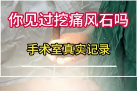 痛风石也能“挖呀挖呀”吗？ #痛风石 #挖呀挖呀挖 #真实记录  #医学科普
