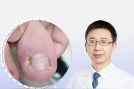 甲沟炎不严重，自己在家都可以处理 快看这个视频，就不要来医院啦~#甲沟炎 #甲沟炎正规处理 #硬核健康科普行动  #健康冷知识知多少视频封面