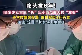 吃了6年！15岁少女胃里取出4斤头发，医生提醒 