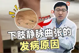 下肢静脉曲张的发病原因 #下肢静脉曲张 #下肢静脉曲张怎么办 #医学科普 #医疗健康创作训练营 #dou是知识视频封面