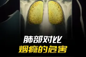 正常人的肺和吸烟者的肺区别这么大，原来都是它们在作祟！