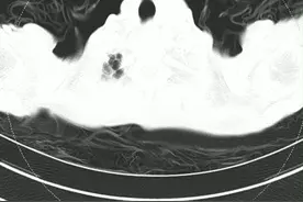 老年男性，咳嗽2年，加重1周，既往IPAF,口服雷公藤+强的松