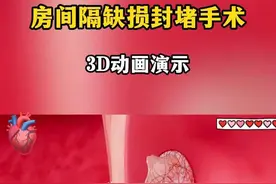 房间隔缺损封堵手术动画演示 房间隔缺损封堵手术动画演示#抖出健康知识宝藏  #情绪松绑给心灵放个假 #先心病 #房缺 #3D动画 