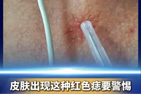 #皮肤出现这种红色痣要警惕  身上突然出现蜘蛛腿一样的红血丝，一按就消失，松开手又会恢复原样，要警惕！这可能是代表着肝功能出现了问题。#谈谈新知  #半月谈